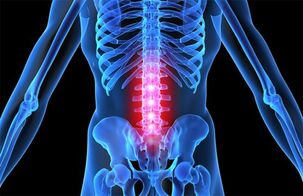 Osteochondrose vun der Lendenwirbelsäule