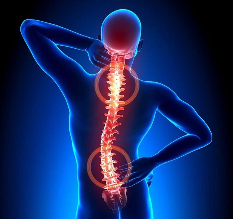 Osteochondrose vun der Wirbelsäule als Ursaach vu Rückenschmerzen