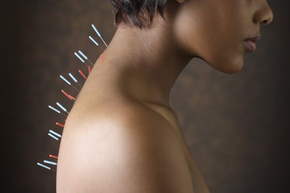 Akupunktur fir Réckwéi