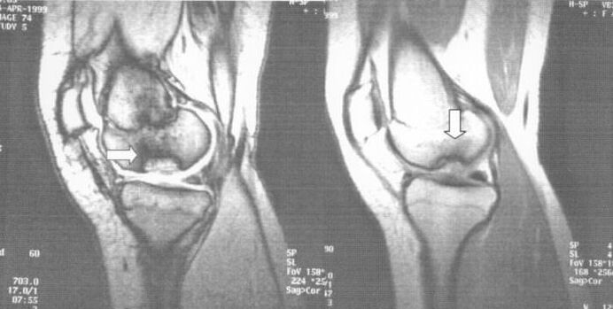Röntgen vun Osteochondrose dissecans am Kniegelenk