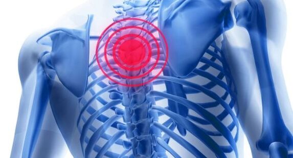 Behandlung vun OsteOchendrosos vun der thoracic Wirbelsäit