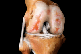 Schied un de Kniegelenk duerch Arthrosis