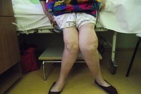 fortgeschratt Arthrosis vum Kniegelenk