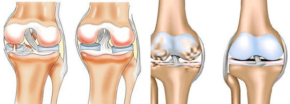 Arthritis an Arthrosis