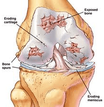 De Mechanismus vun der Entwécklung vu Arthrosis